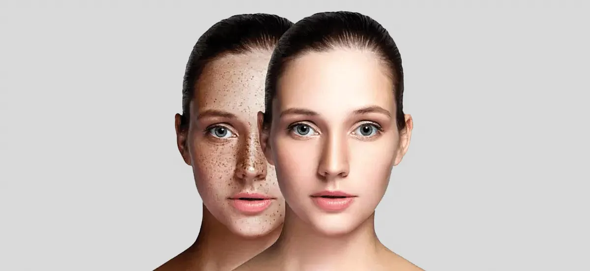 How to Get Rid of Hyperpigmentation a