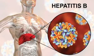 hepatitis-B